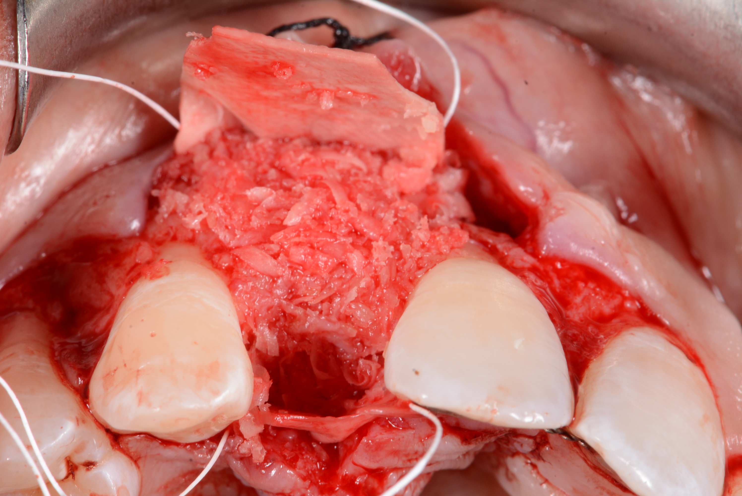 Perform alveolar ridge grafting
