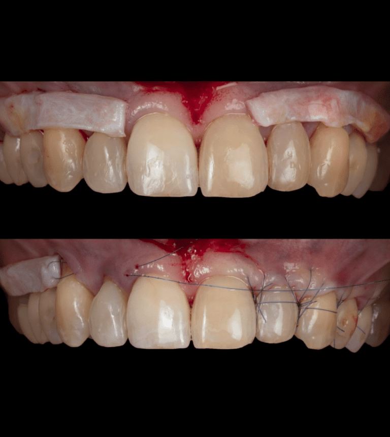 Apply coronally advanced flap techniques