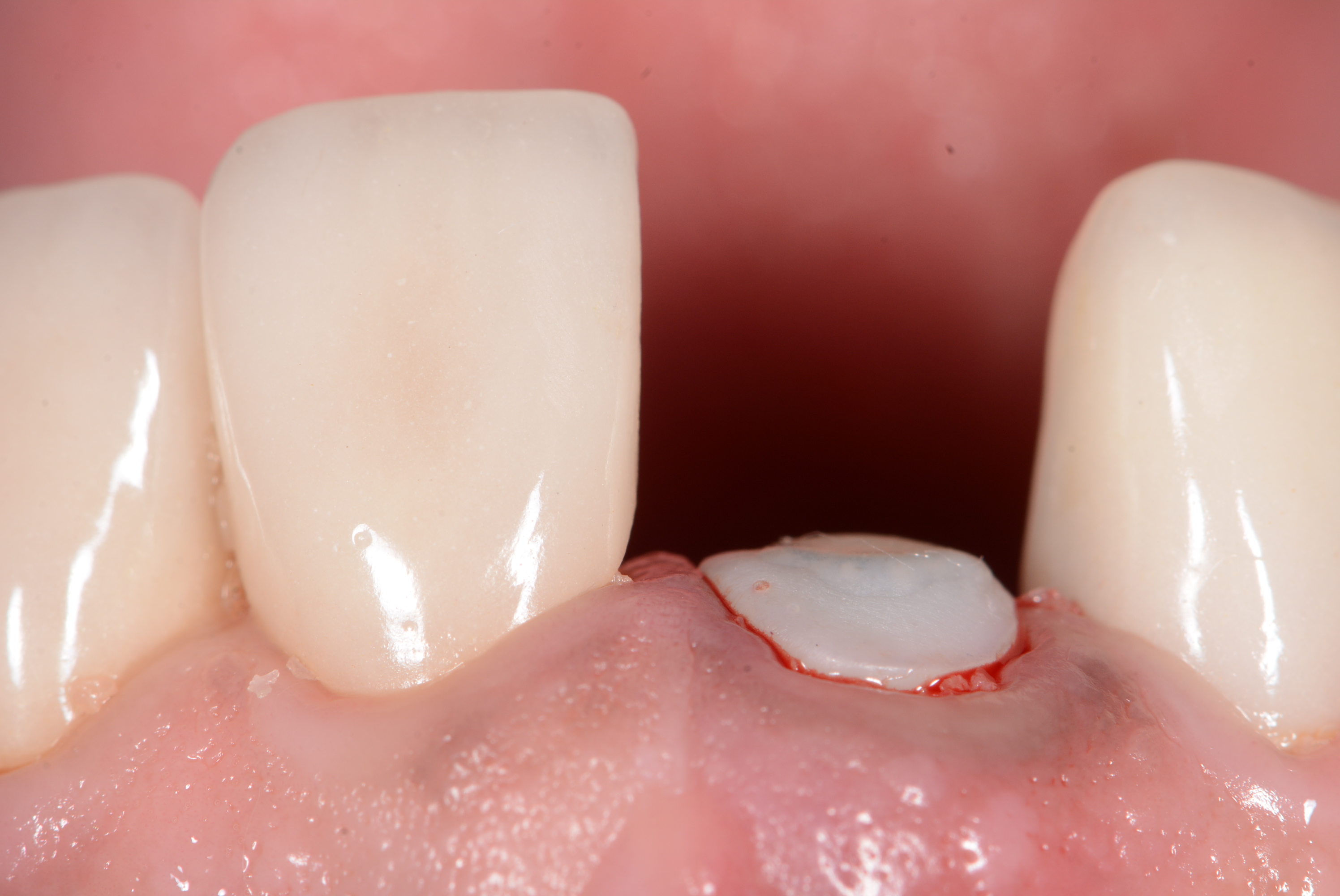 Choose guided or freehand surgery