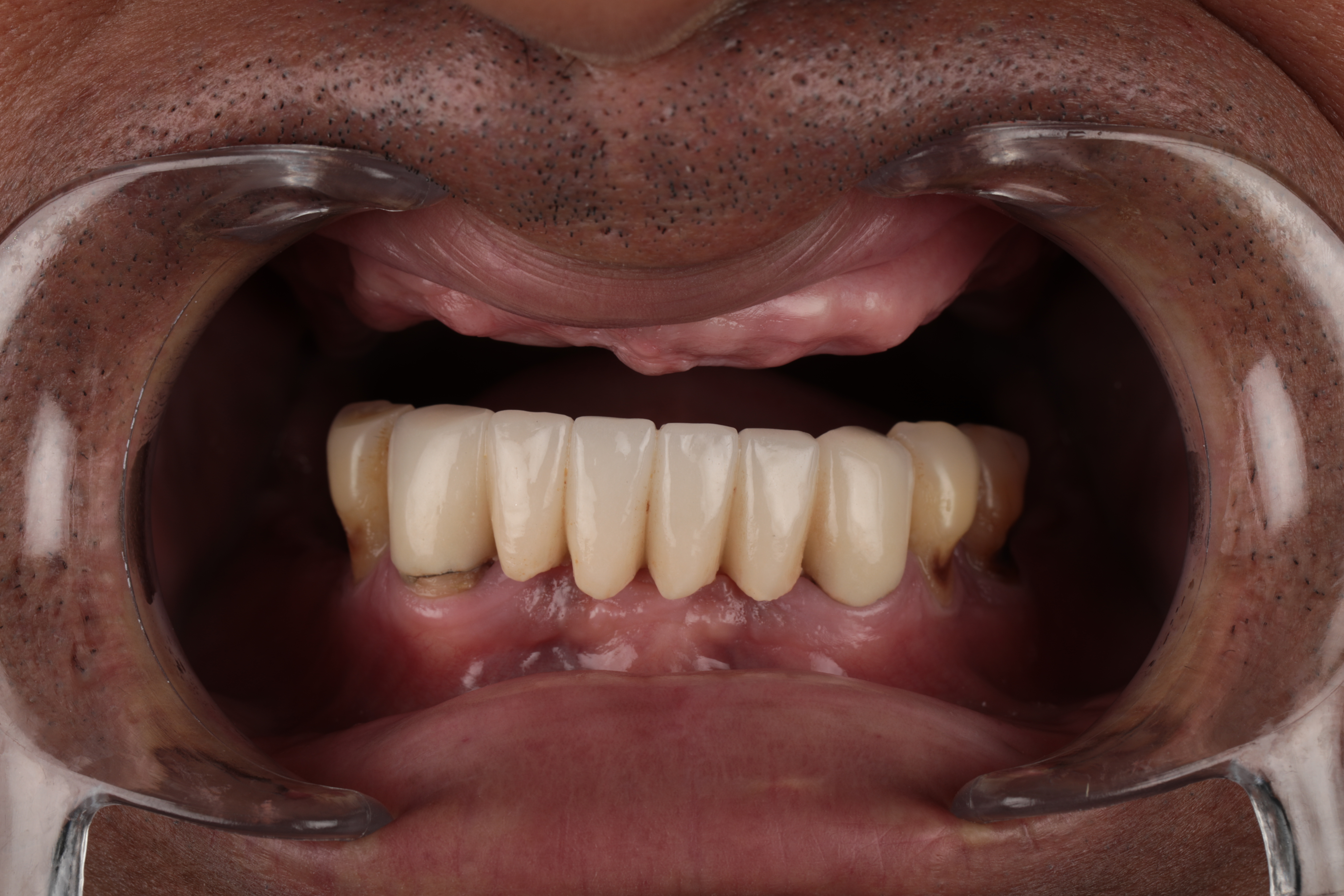 Position implants for the prosthesis