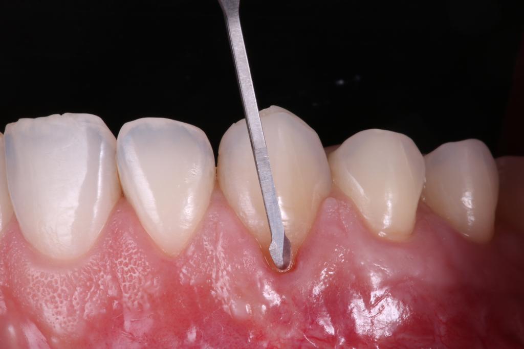 Soft Tissue Management