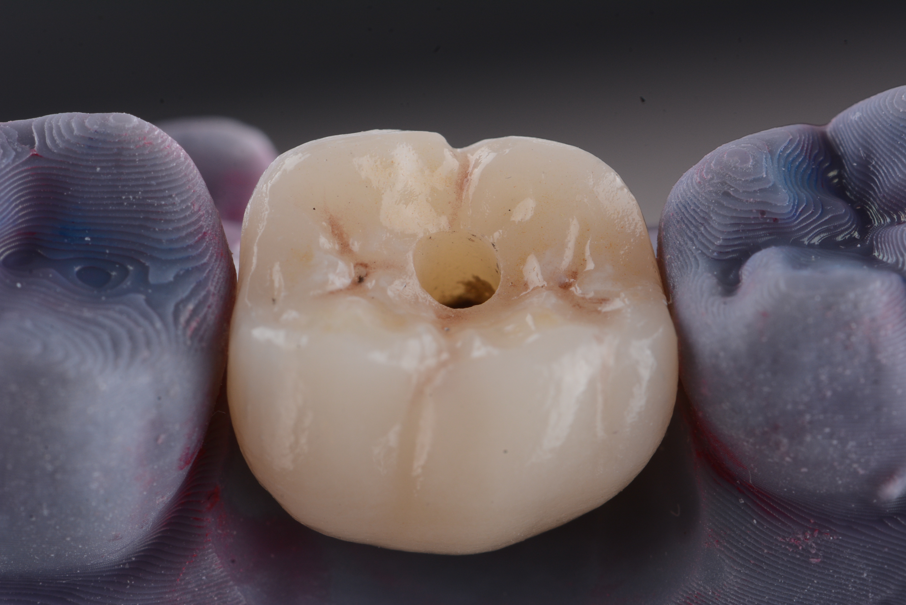 Customize healing abutments