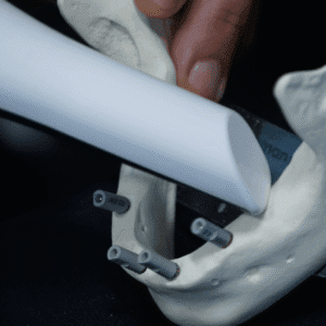 Implant Overdentures: Surgical & Prosthetic Workflow